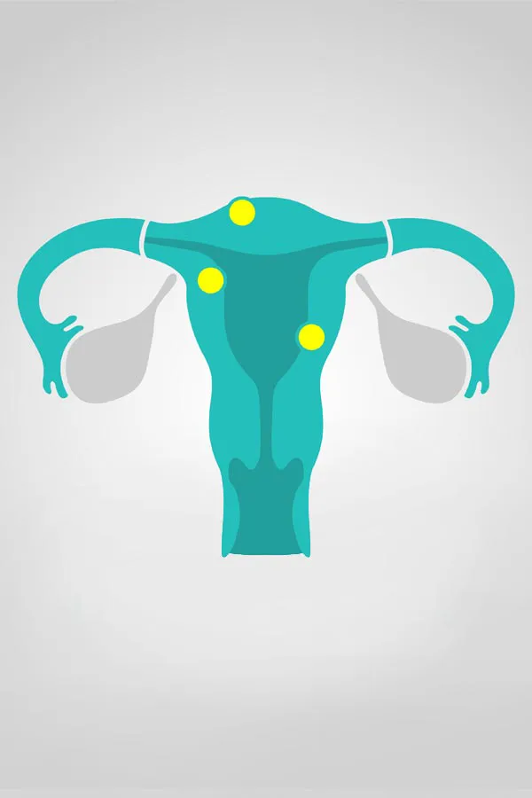 Illustration of a uterus with yellow dots indicating fibroids. Get treatment for fibroids from The Cove Concierge Medicine in Denver.